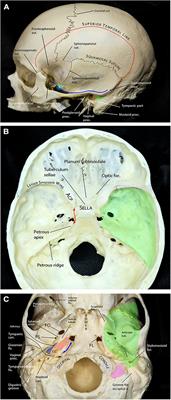 Comprehensive microsurgical anatomy of the middle cranial fossa: Part I—Osseous and meningeal anatomy